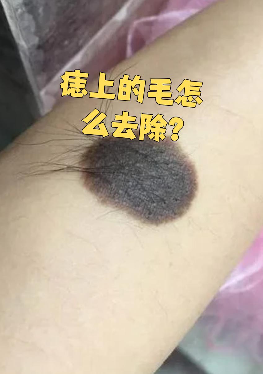 痣上长毛通常是黑毛痣,属于色素痣的一种,可能和遗传或紫外线照射有