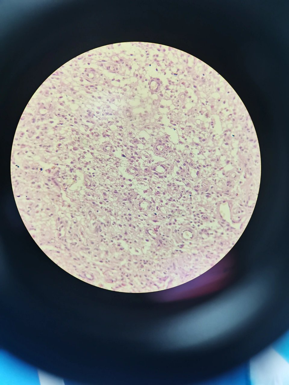 病理切片-肉芽组织 病理描述:肉芽组织(granulation tissue)是指由