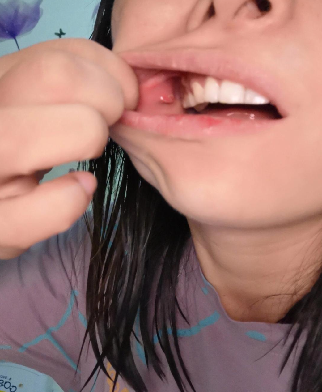 嘴里长了个包可能有很多原因,比如肿瘤,口腔粘液腺囊肿,淋巴结发炎