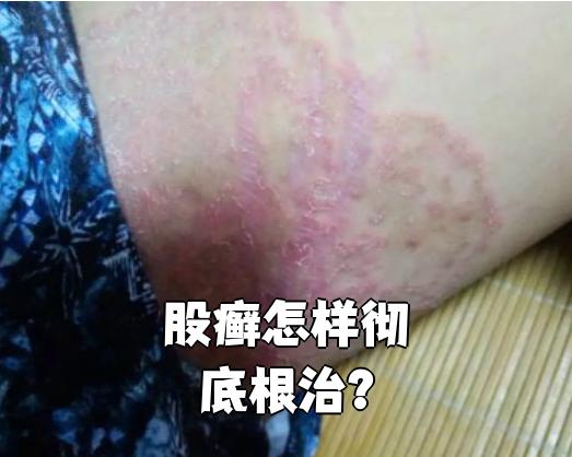 要彻底根治股癣,关键是要坚持规范治疗,同时做好日常护理