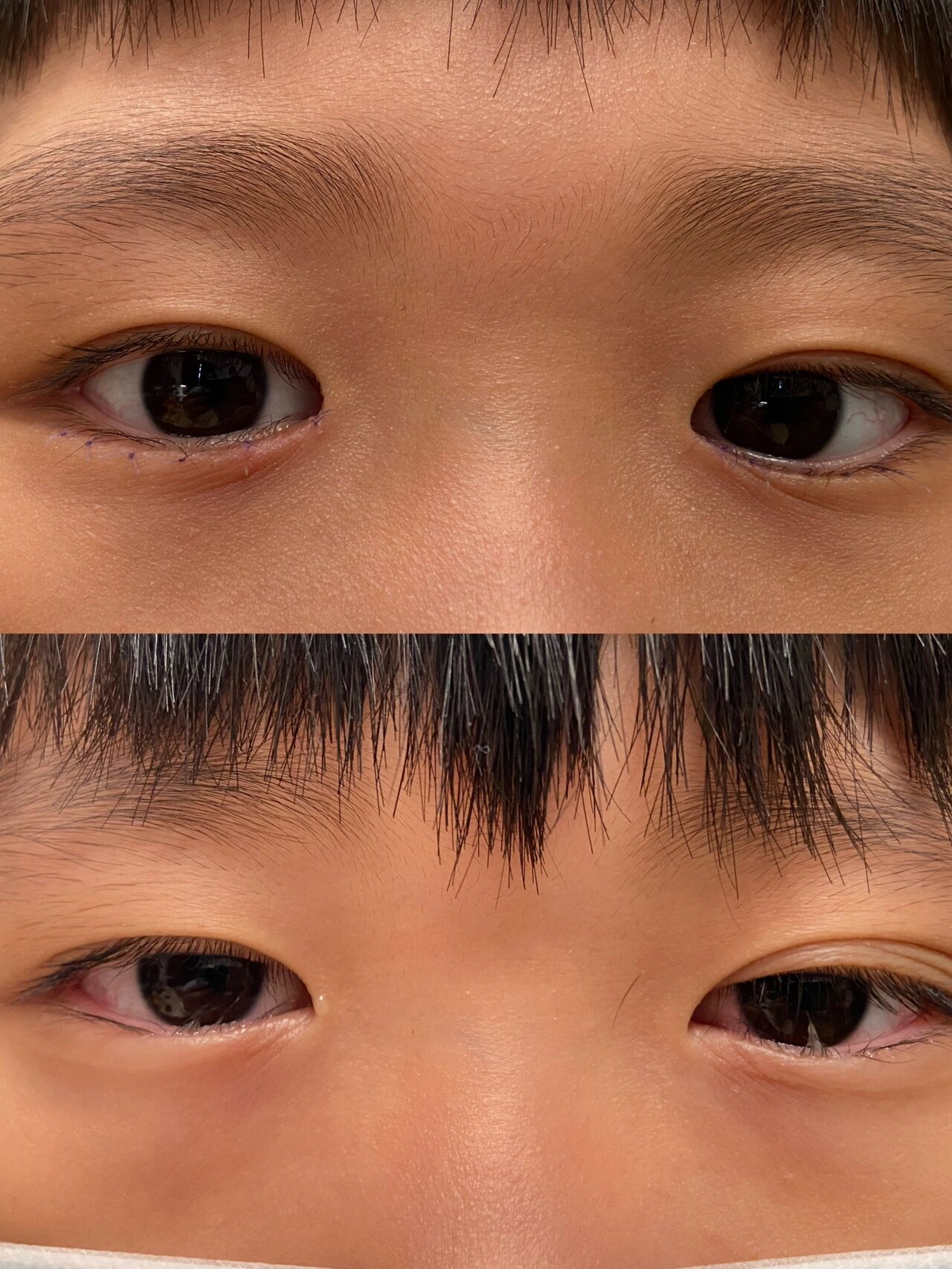 先天性睑内翻倒睫 可刺激眼睛红流泪 严重时可导致角膜溃疡影响视力