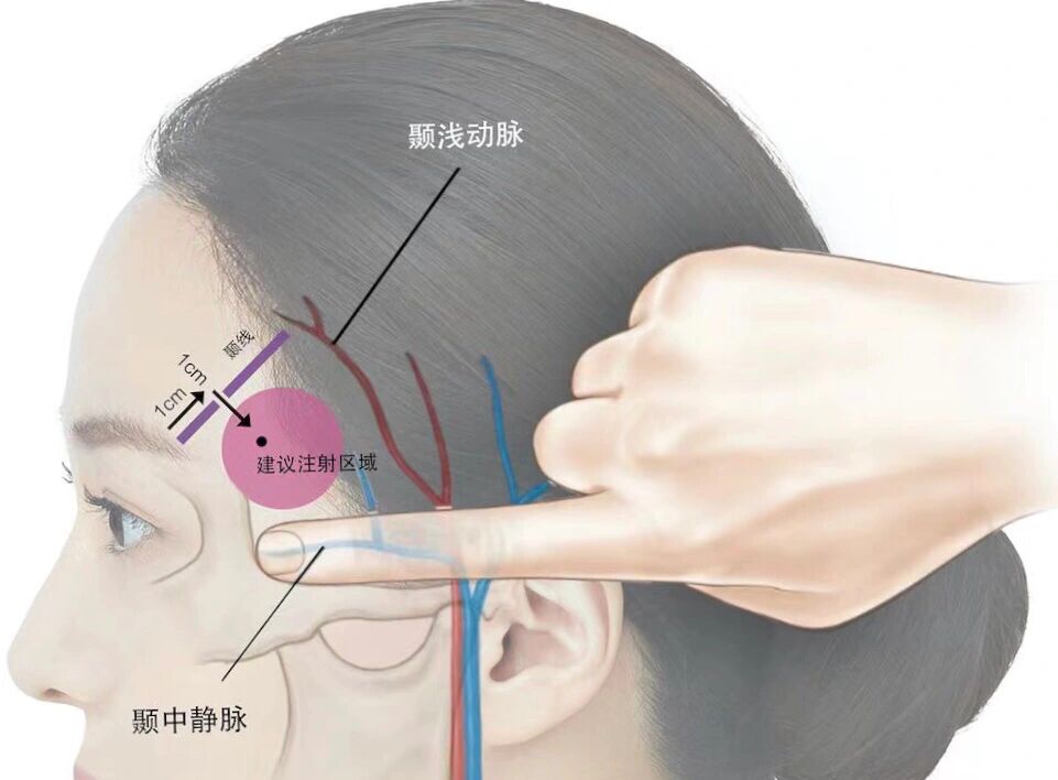 颞浅动脉图片图片