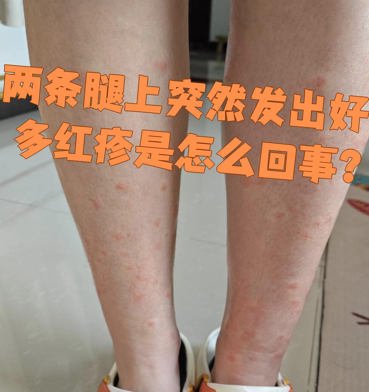如果是荨麻疹,通常和食物添加剂,皮肤受刺激,情绪紧张有关