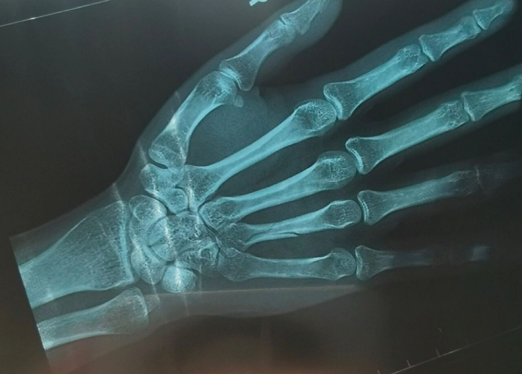 右手第四掌骨骨折"保守治疗"带支具 心累啊!