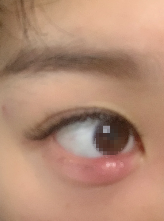 眼皮上长肉刺可能是丝状疣,麦粒肿或皮脂腺囊肿引起的,不同情况错理