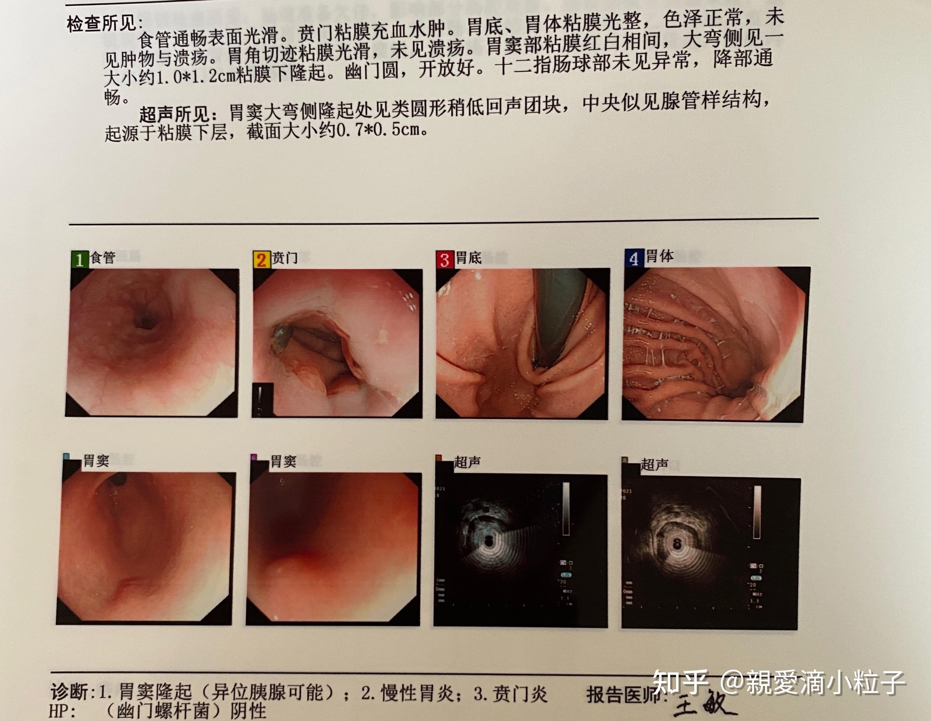 胃窦间质瘤异位胰腺傻傻分不清楚