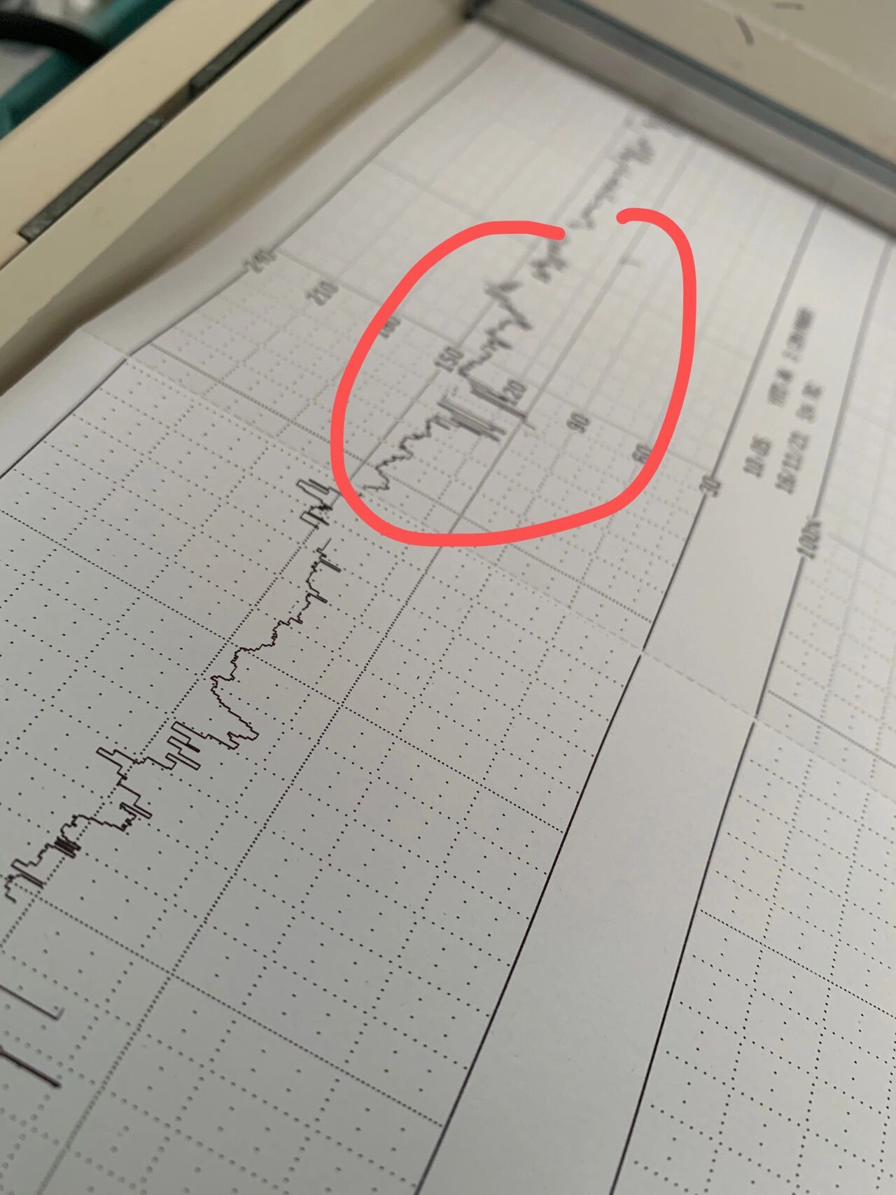孕后期变异减速经历(附胎心监护攻略) 总算能闲下来写一写自己孕后期