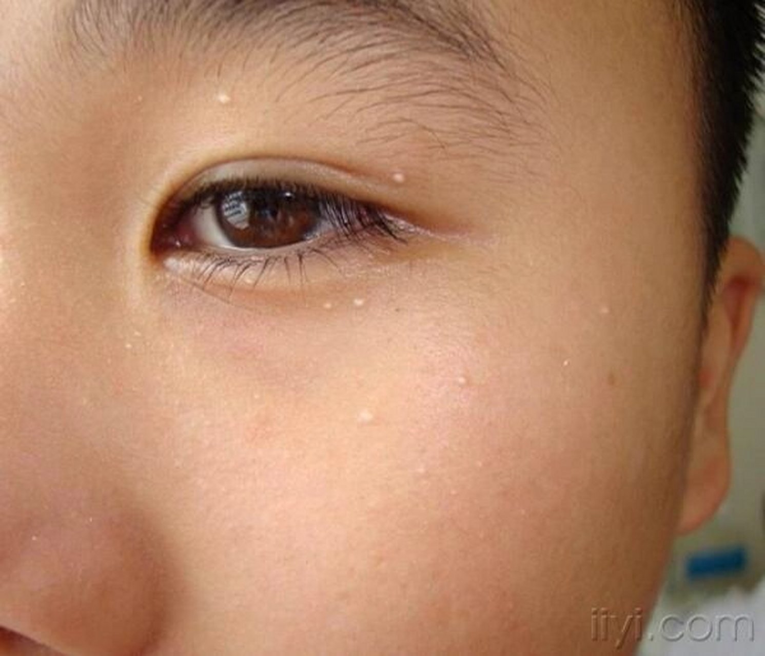 每日科普:粟丘疹～俗称脂肪粒,常发生于眼睑,面颊等部位,为黄白色