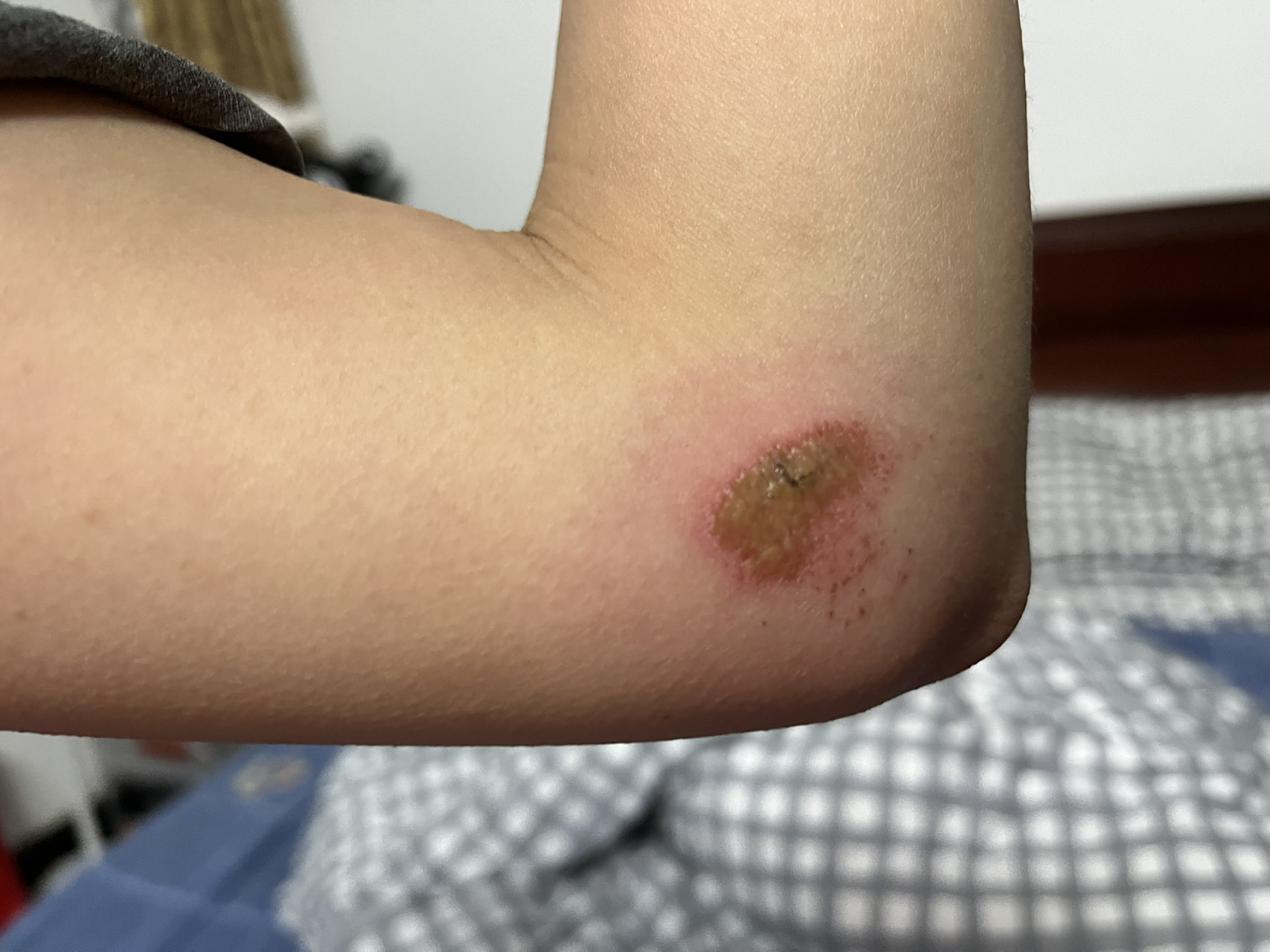 求求了攀岩手臂擦伤,如何处理发炎长脓包. .