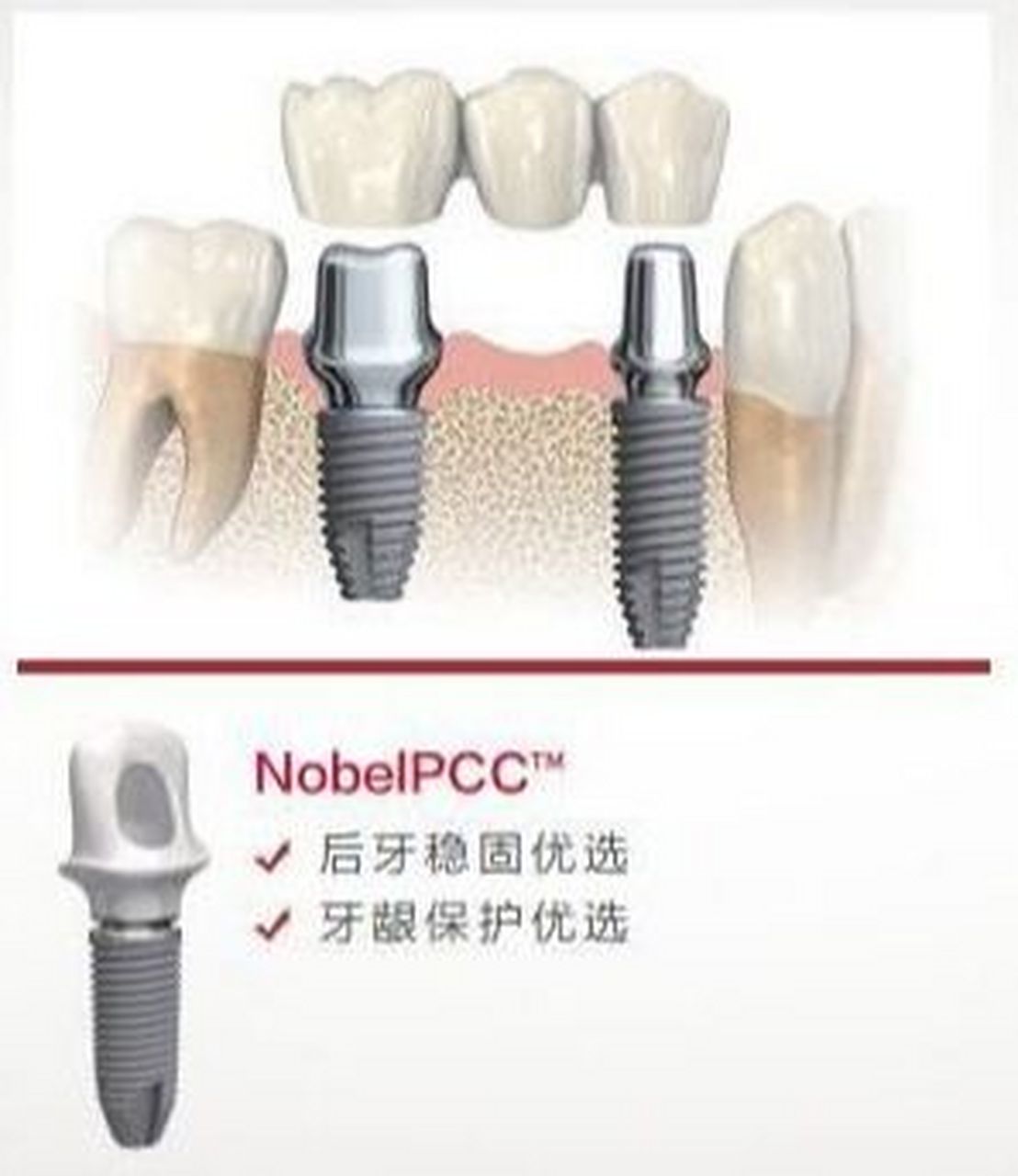 诺贝尔nobel biocare ☆02 nobel biocare(瑞典诺贝尔种植体)