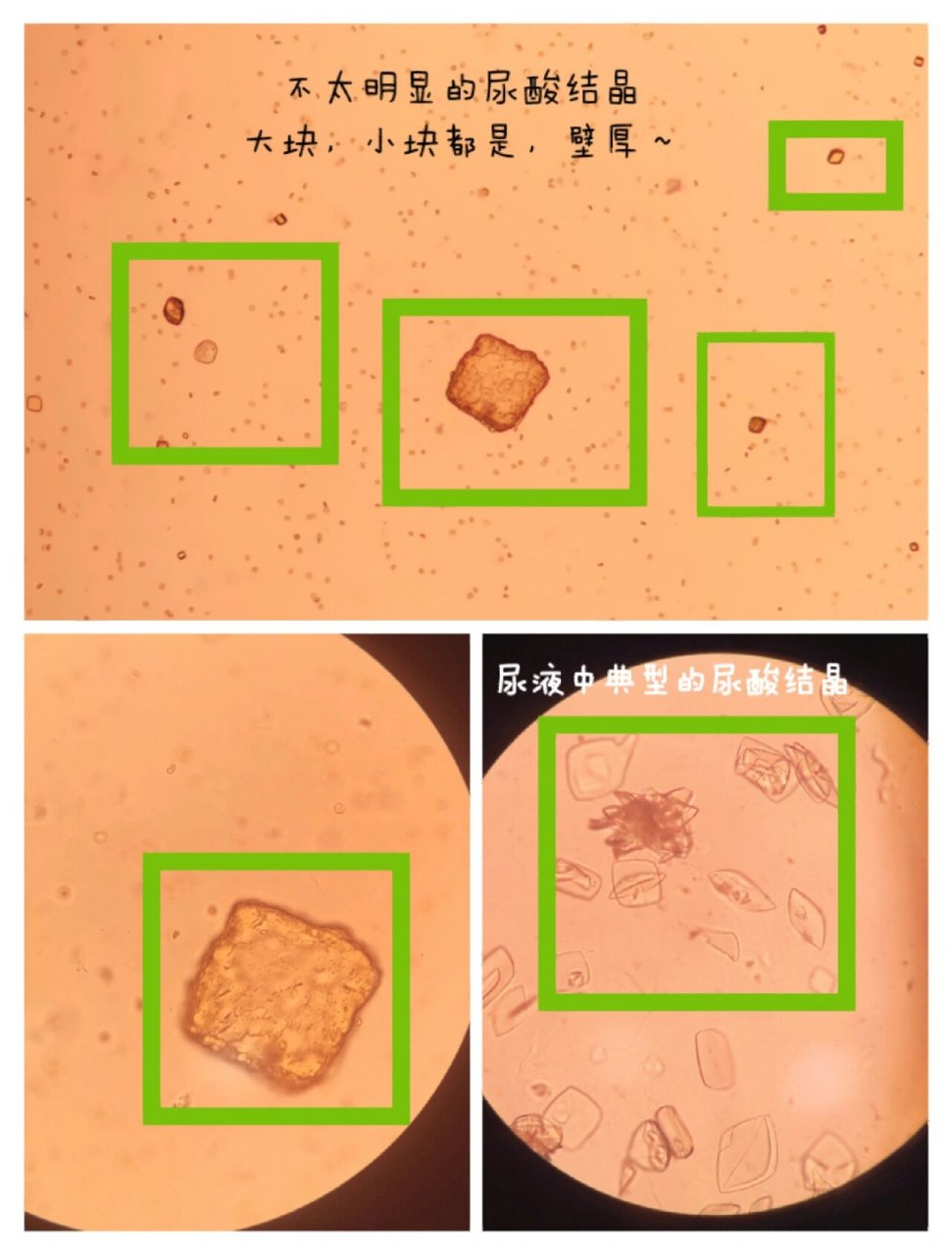 痛风结晶显微镜图片