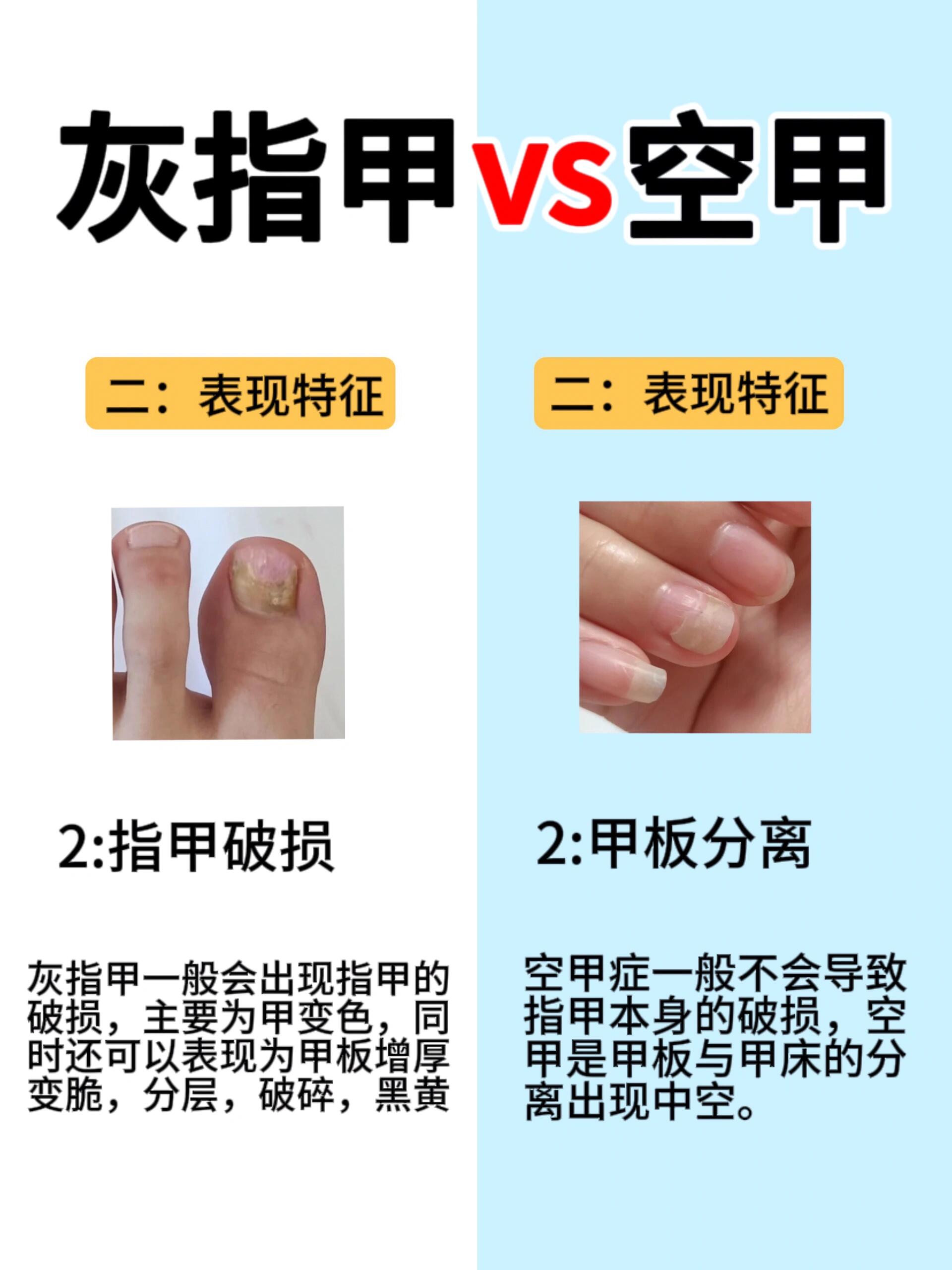 这种指甲空了变黄就是灰指甲吗?