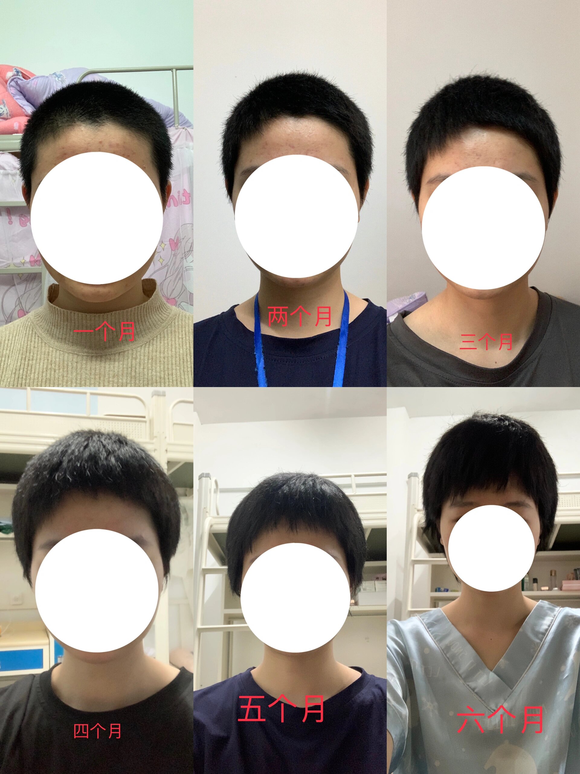 光头蓄发半年啦