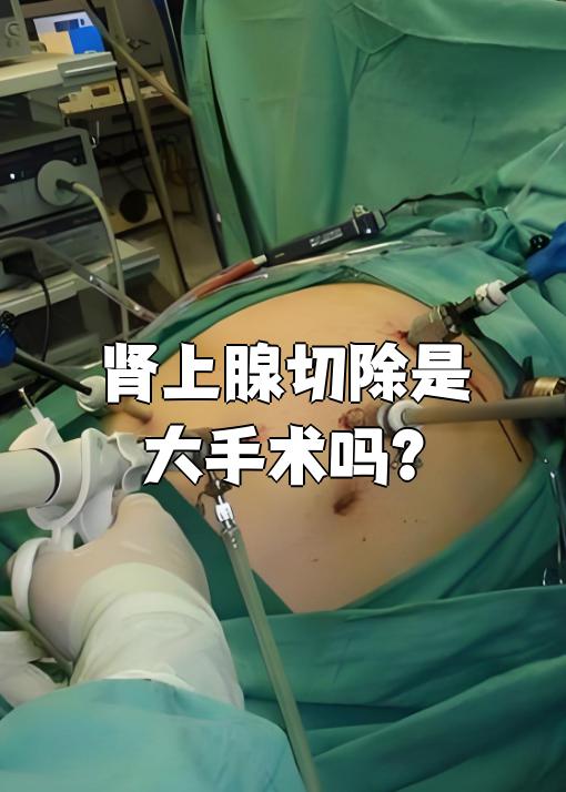 肾上腺切除是大手术吗?