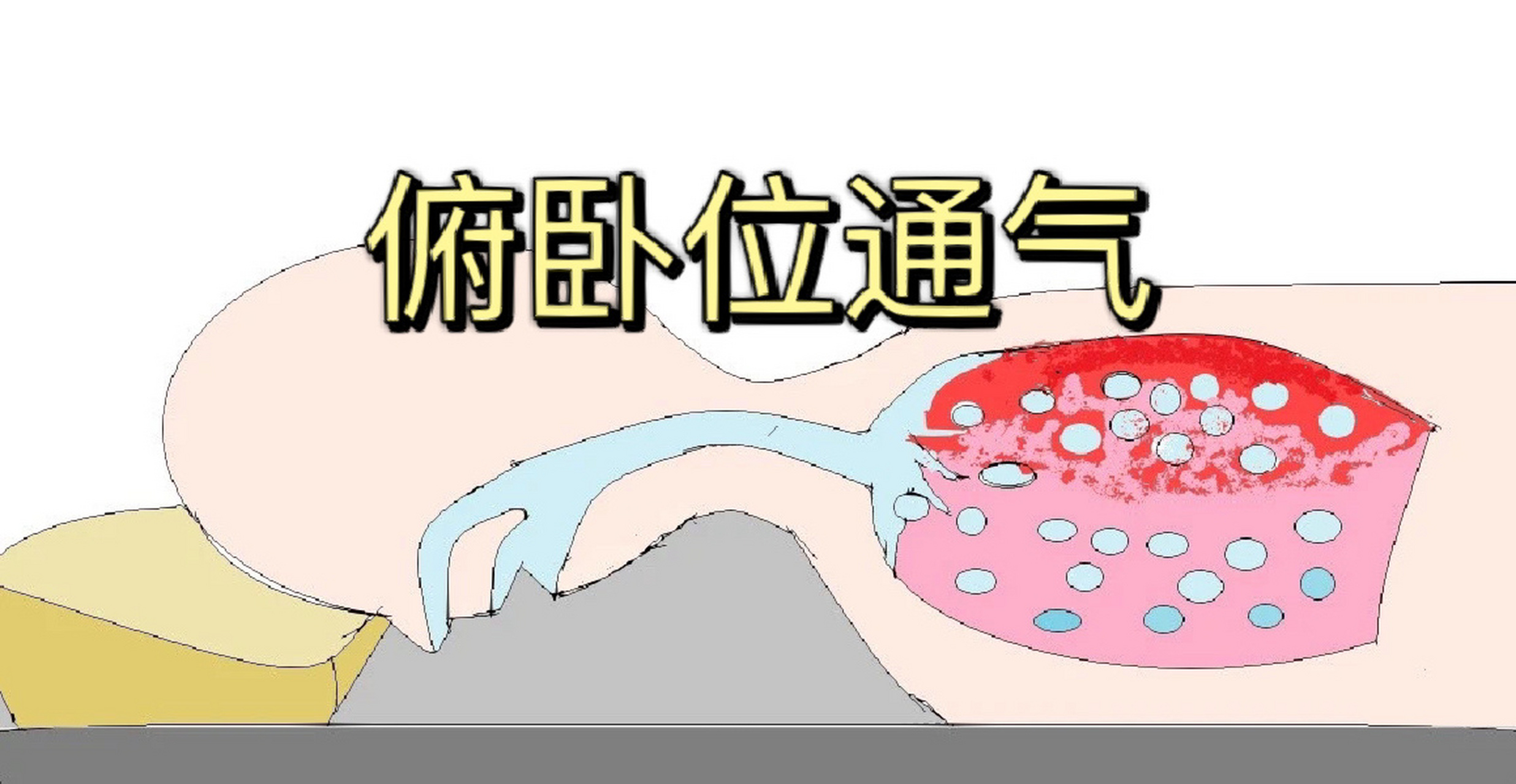 俯卧位通气:三个枕头缓解呼吸困难!