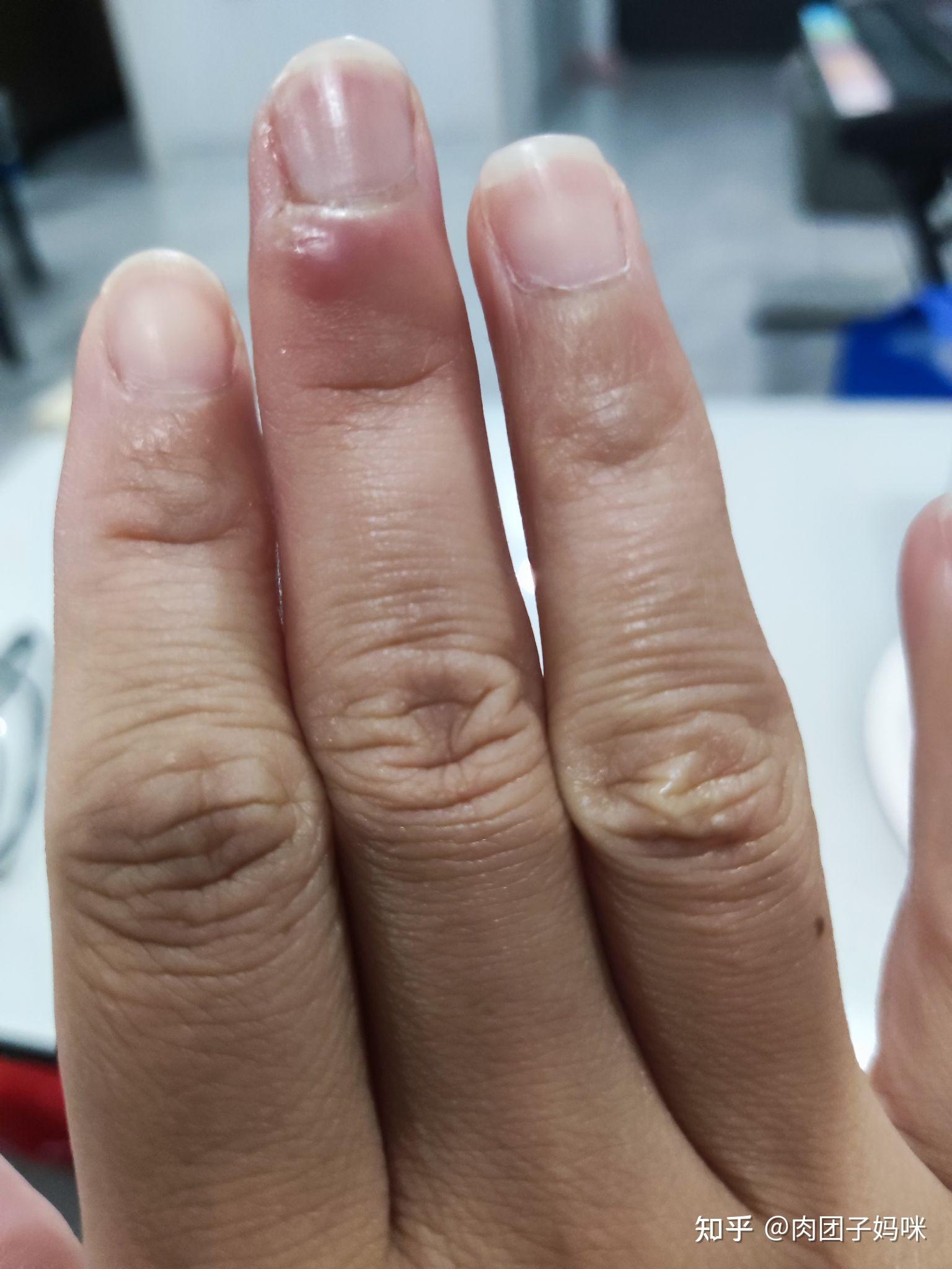 拔手指倒刺导致甲沟炎