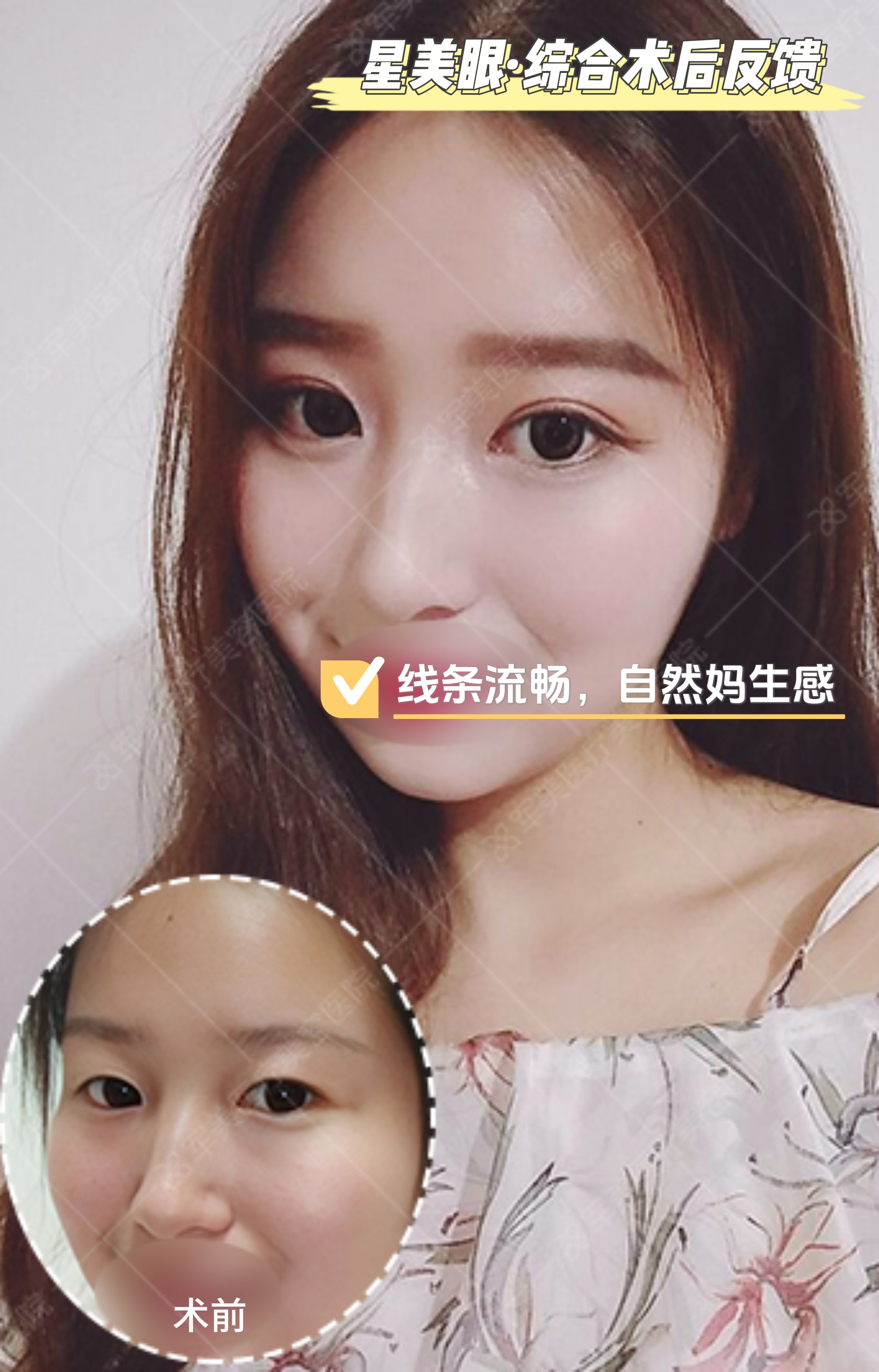 为什么割双眼皮