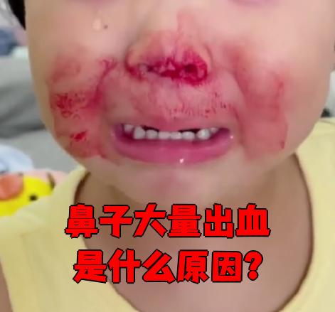 鼻子大量出血可能由多种原因引起,常见的有鼻中