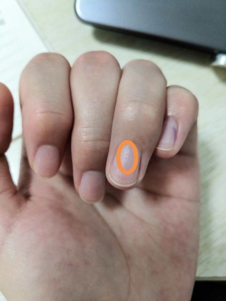 指甲上的小坑坑 每次涂完指甲油后,指甲上都会长这种蜂窝状的小坑.