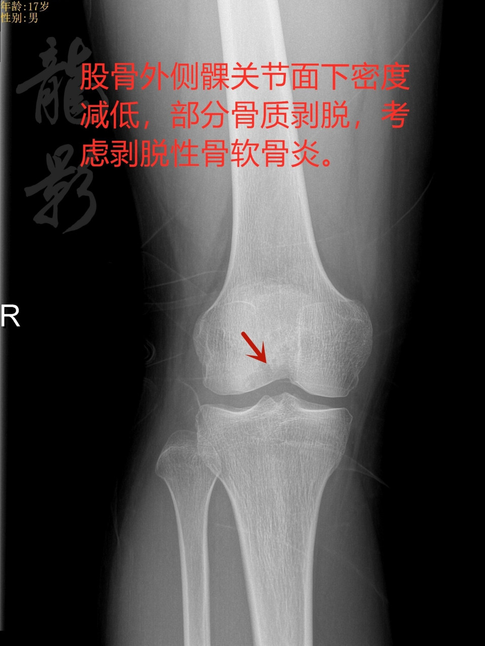 严重的软骨病图片图片