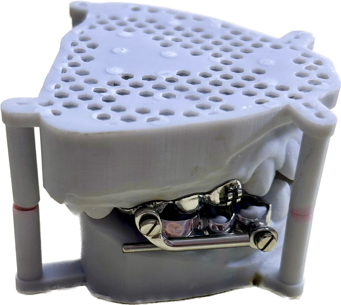 herbst 咬颌前移器(导下颌向前) herbst矫治器,是一种固定的功能性