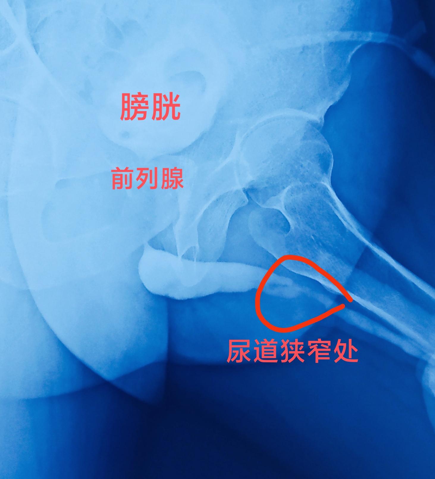 马虫 医生 的想法: 一例严重的尿道狭窄,排尿只能一滴滴地流出来,我们