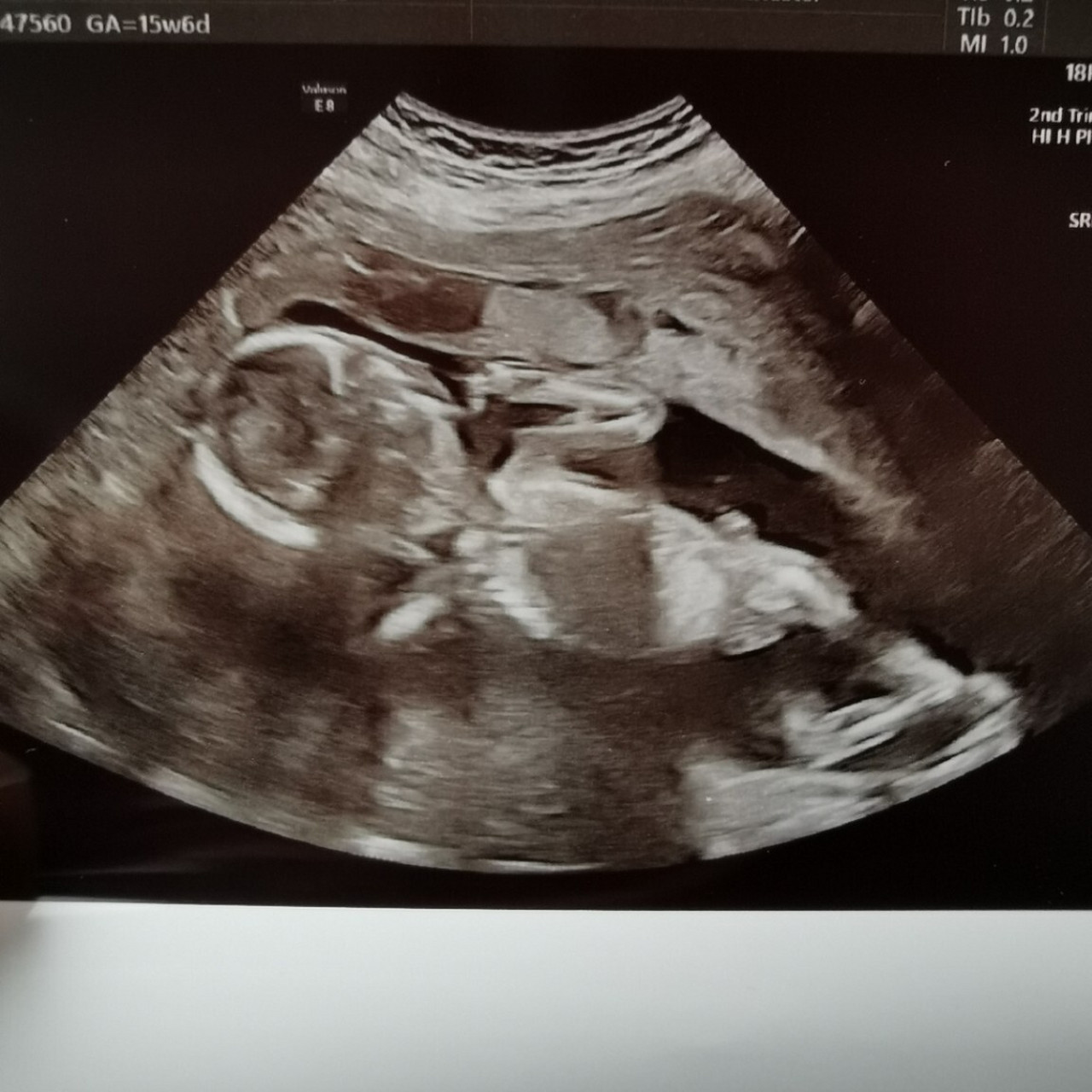 孕16周胎儿彩超图图片