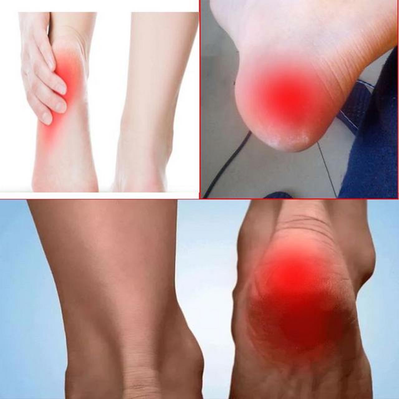 李茂发治疗足跟疼(李茂发一病一方治脚背脚腕病方)