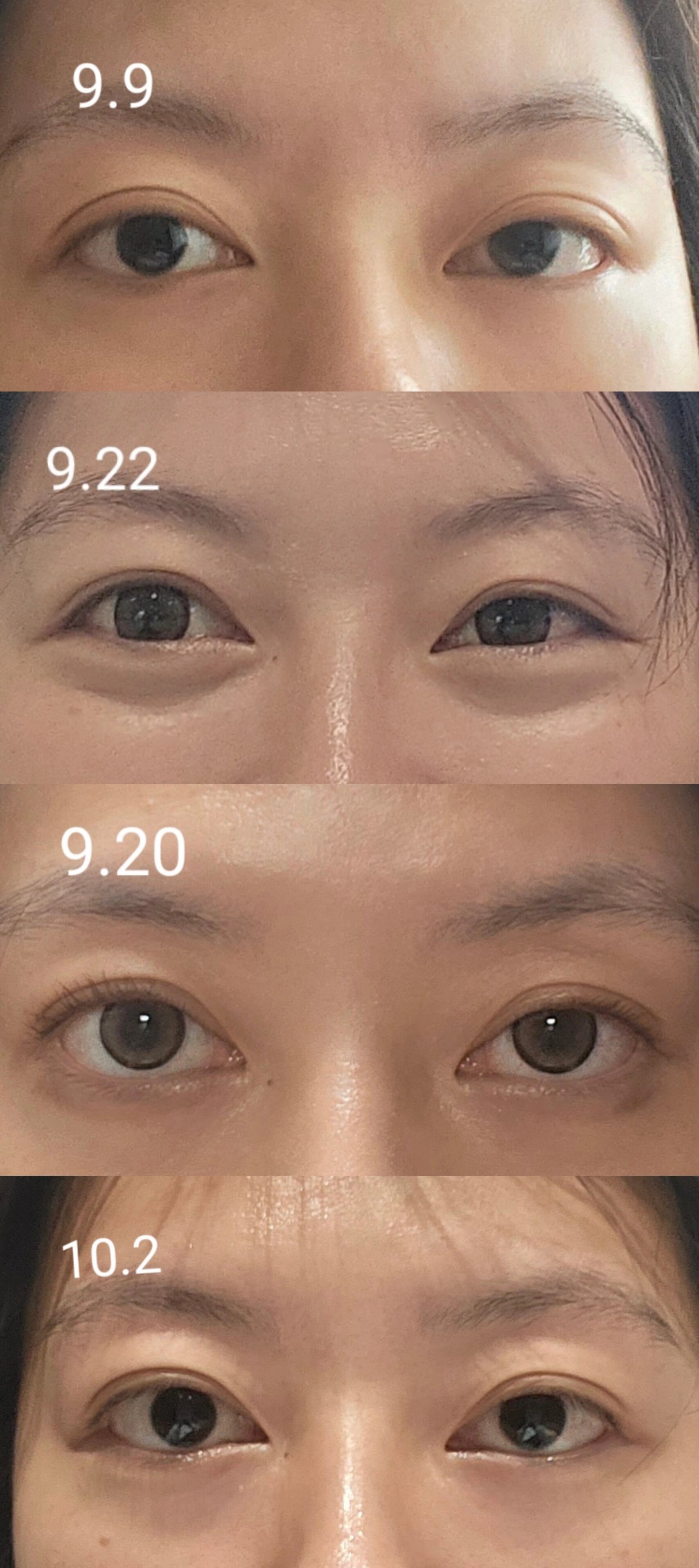 甲亢大小眼注射曲安奈德分享