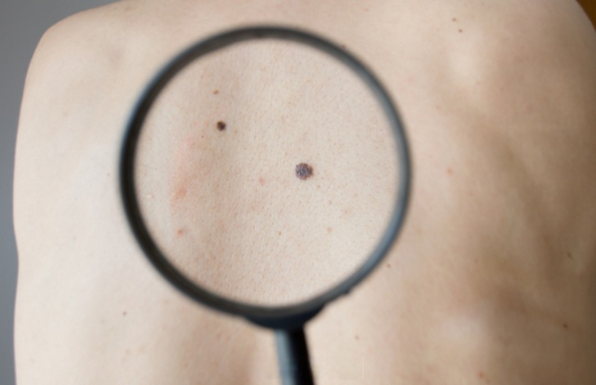 【小伙腿上黑痣增大竟是黑色素瘤 】近日,家住长沙市天心区的吴哲(化