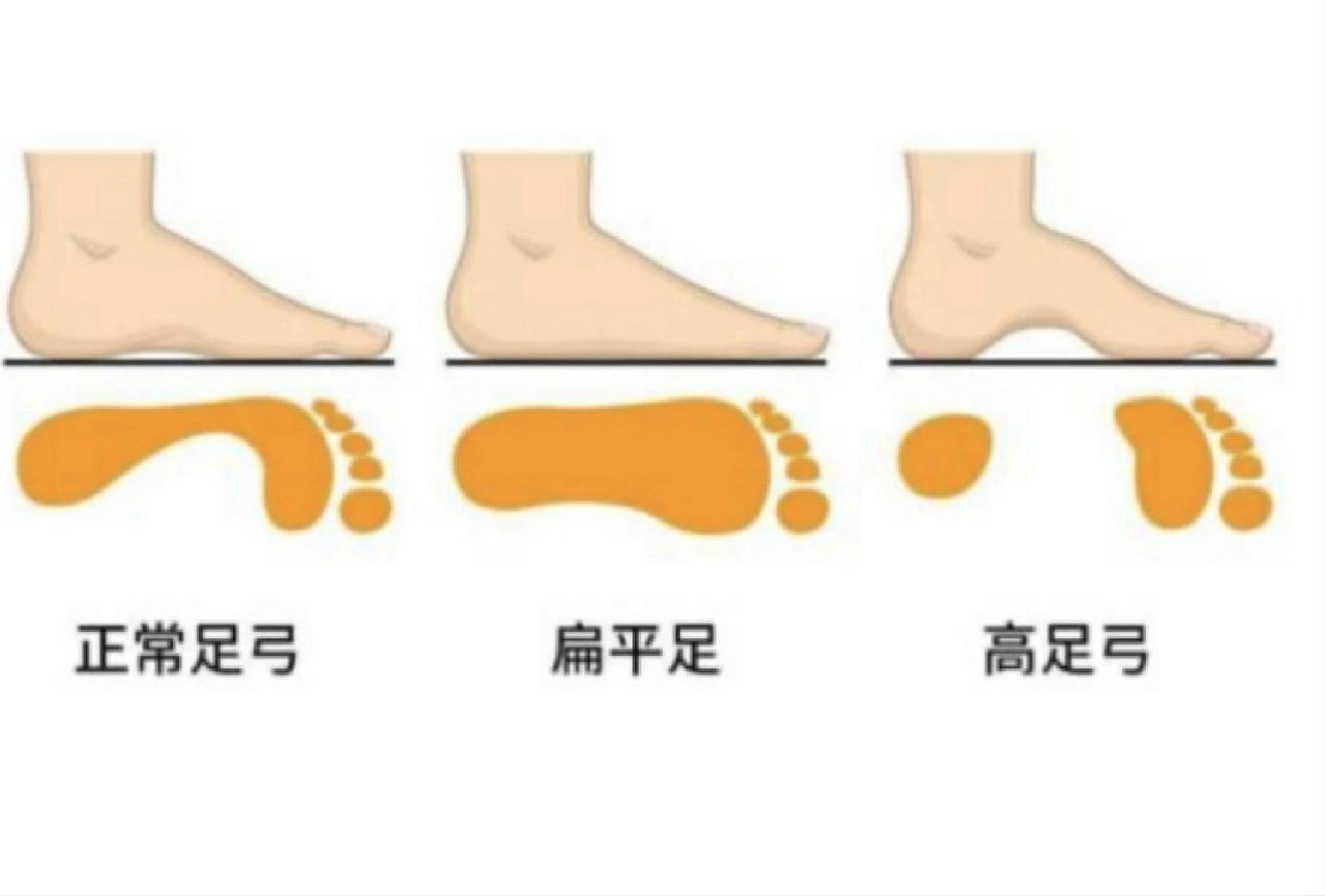 普拉提私教|扁平足◆高足弓61调整方案 扁平足形成原因: 与坐姿时