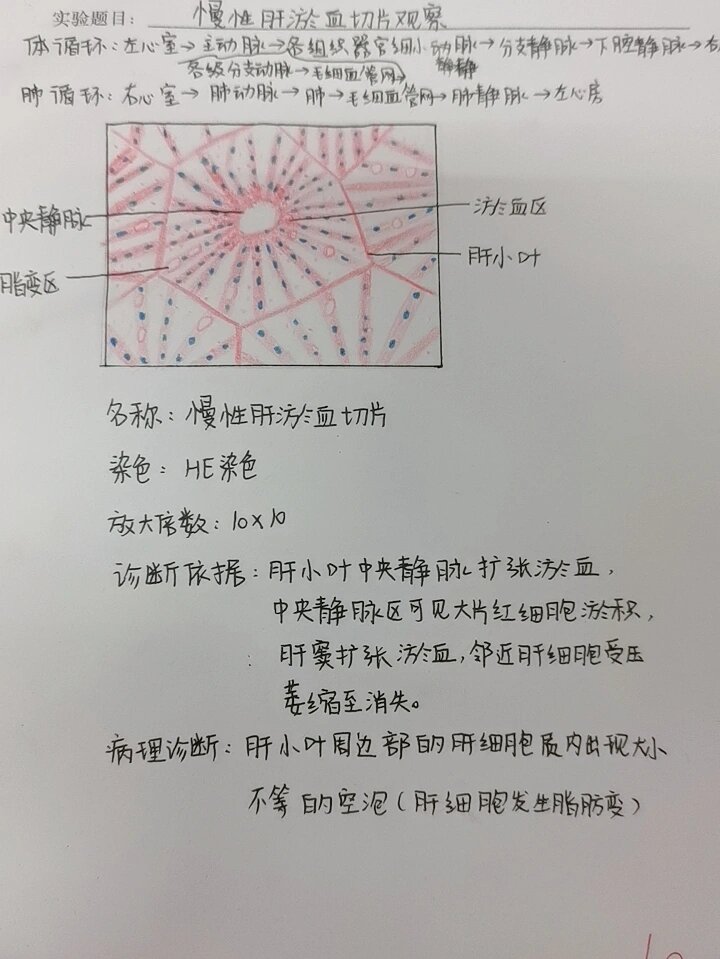 慢性肝瘀血红蓝铅笔绘图