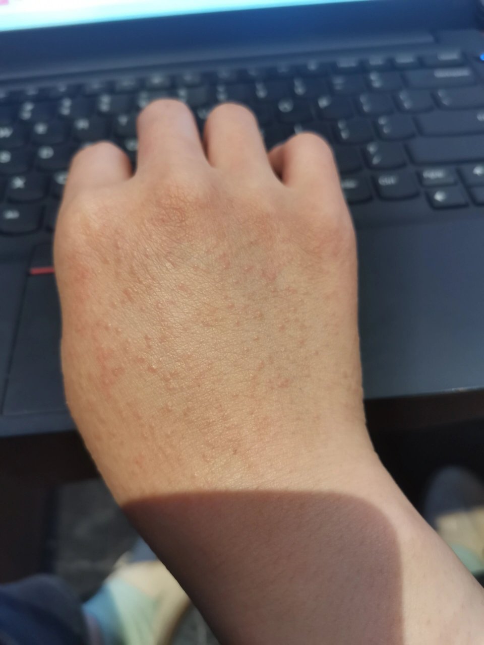 手背突然长了很多小疙瘩 还发红 这是什么疹子呀   怎么会突然这样
