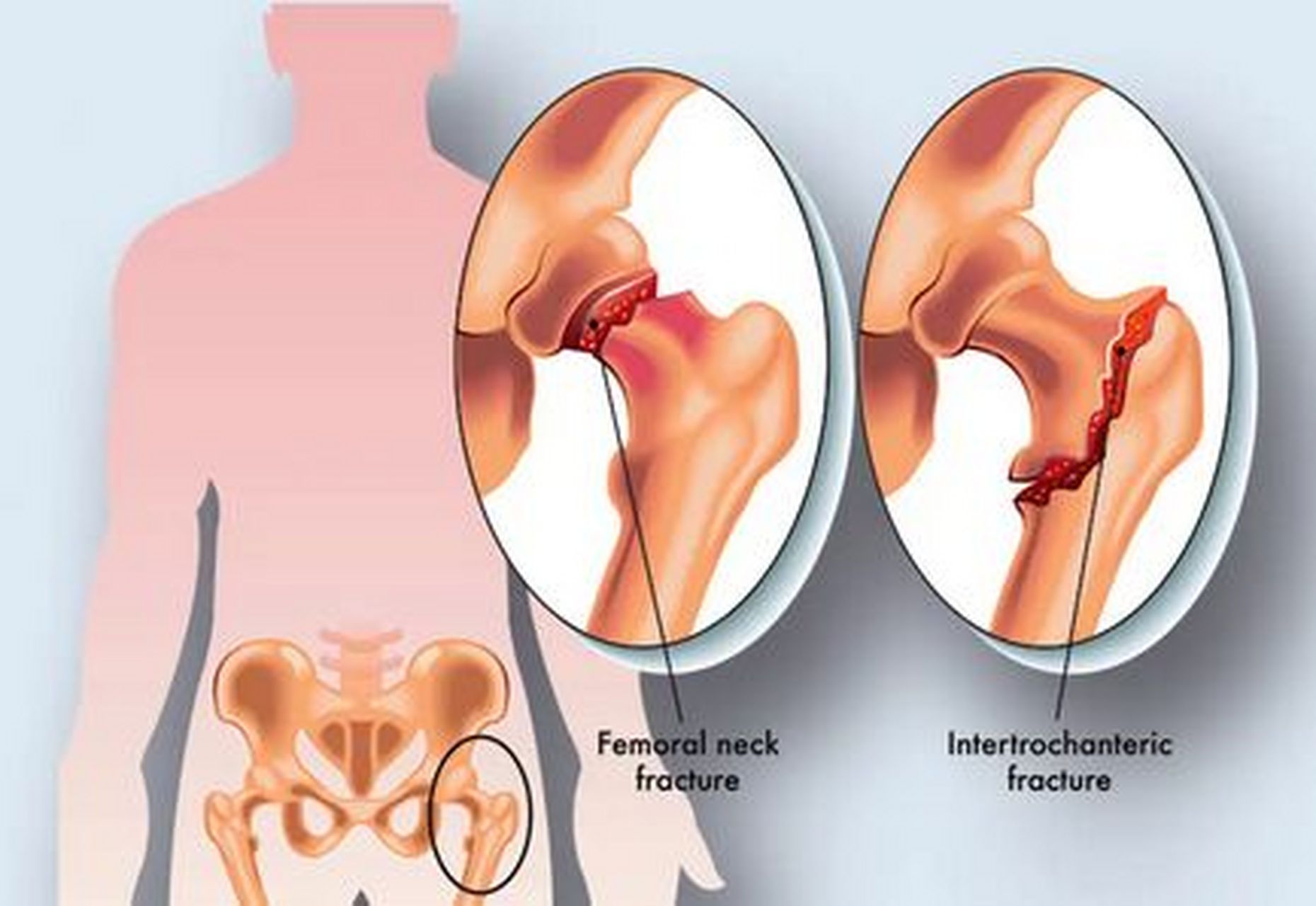 骨折以后,骨痂形成需要多久?
