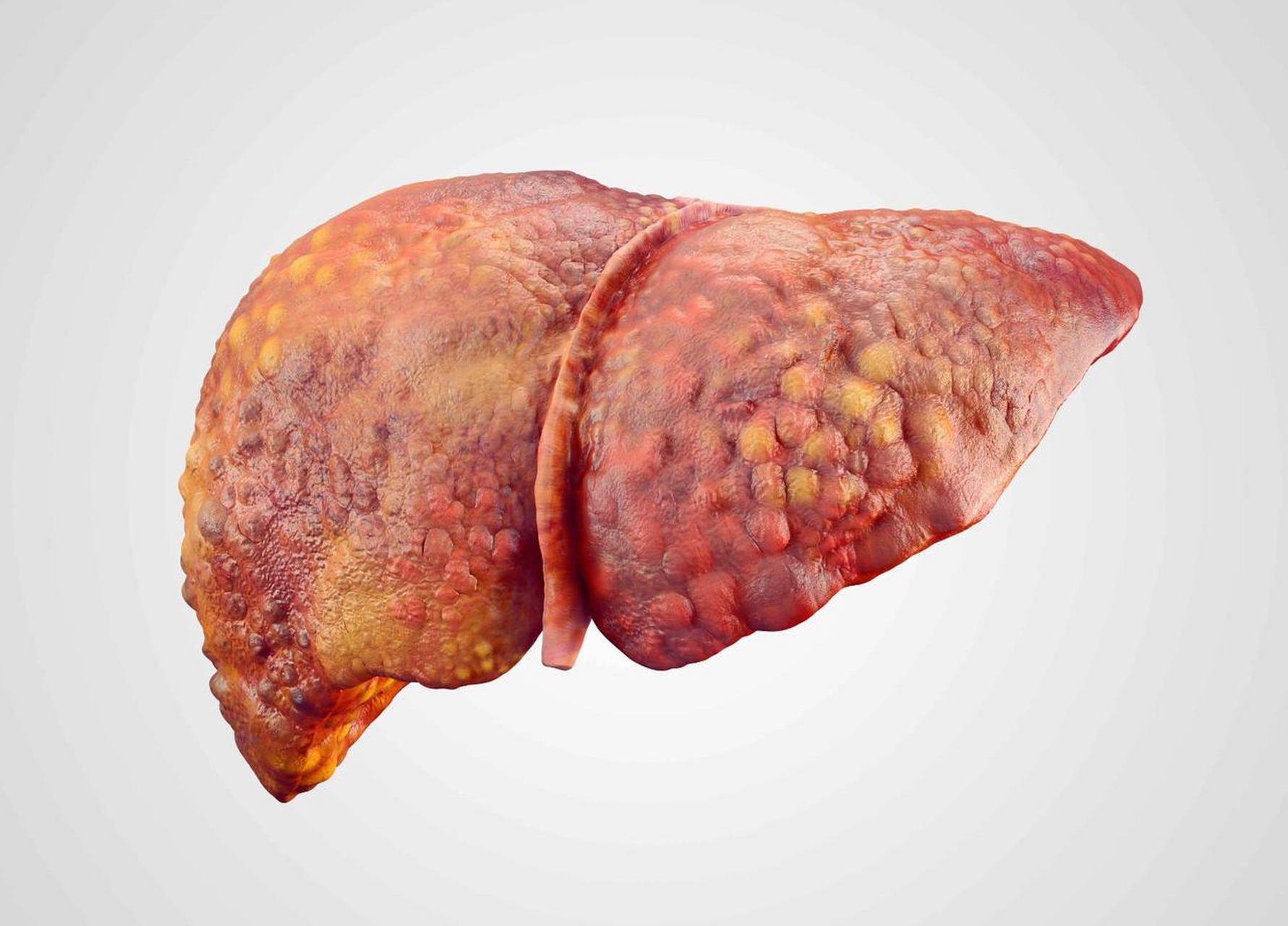 今天(7月28日)是第十三个"世界肝炎日",我国是一个"乙肝大国",体检