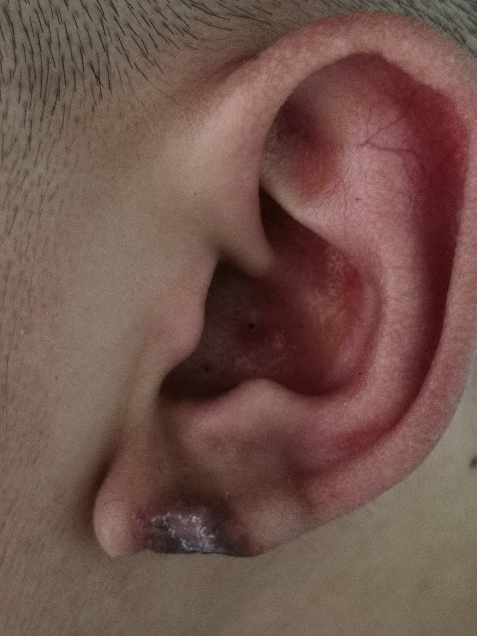 耳廓边缘皮肤纤维瘤.