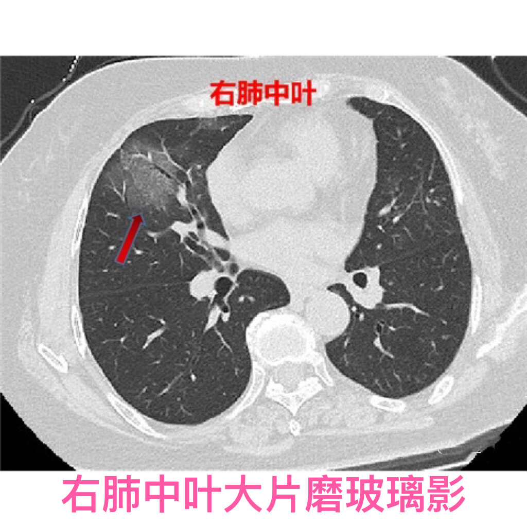 新冠肺炎的ct影像学表现