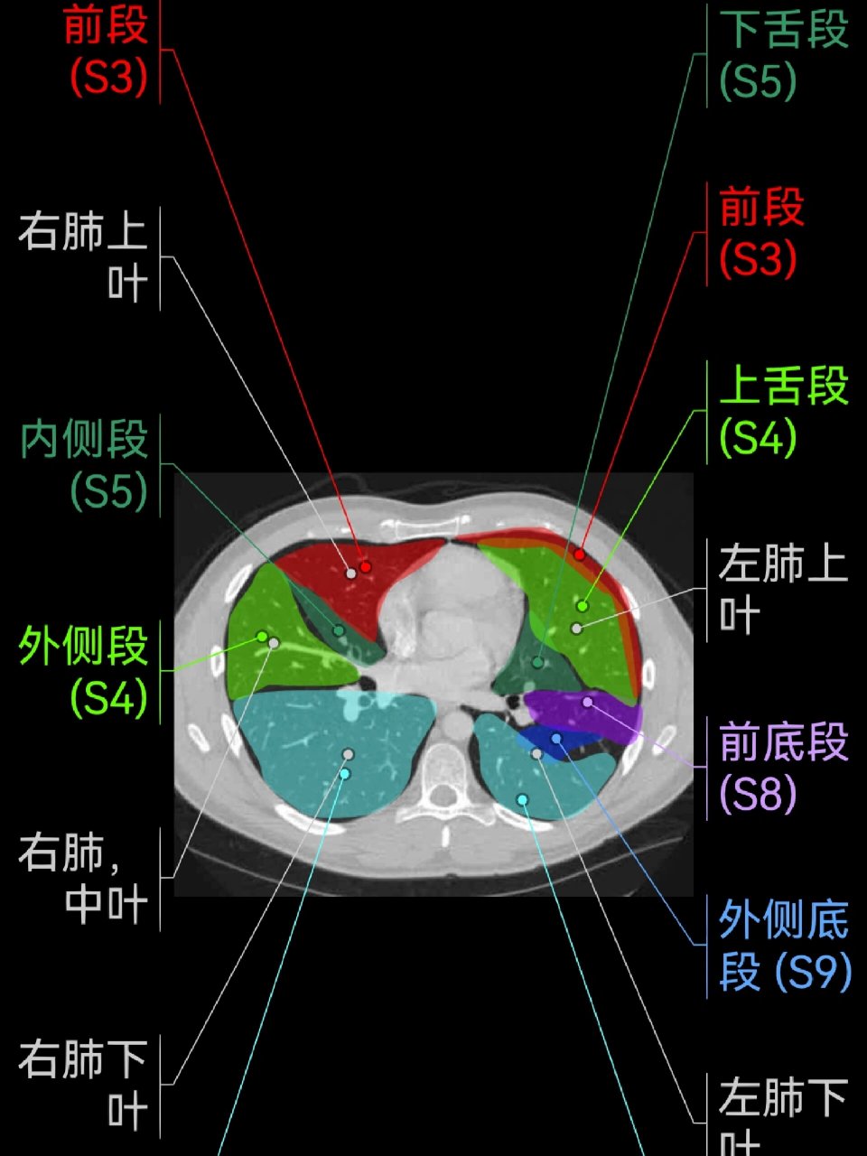 肺的ct分段(高清)|影像学习app 复习基础知识 	 右肺 上叶:s1:尖段;s2