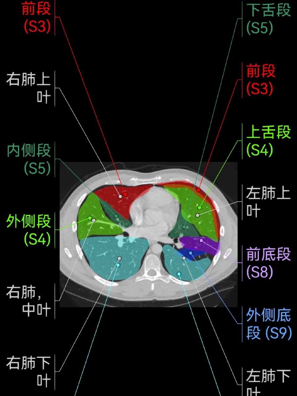 ct肺分叶分段解剖图图片