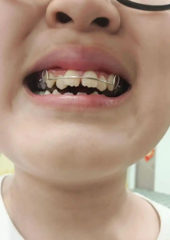 但如果包得太深就不正常了,这叫深覆合或深覆盖,需要做牙齿矫正或正颌