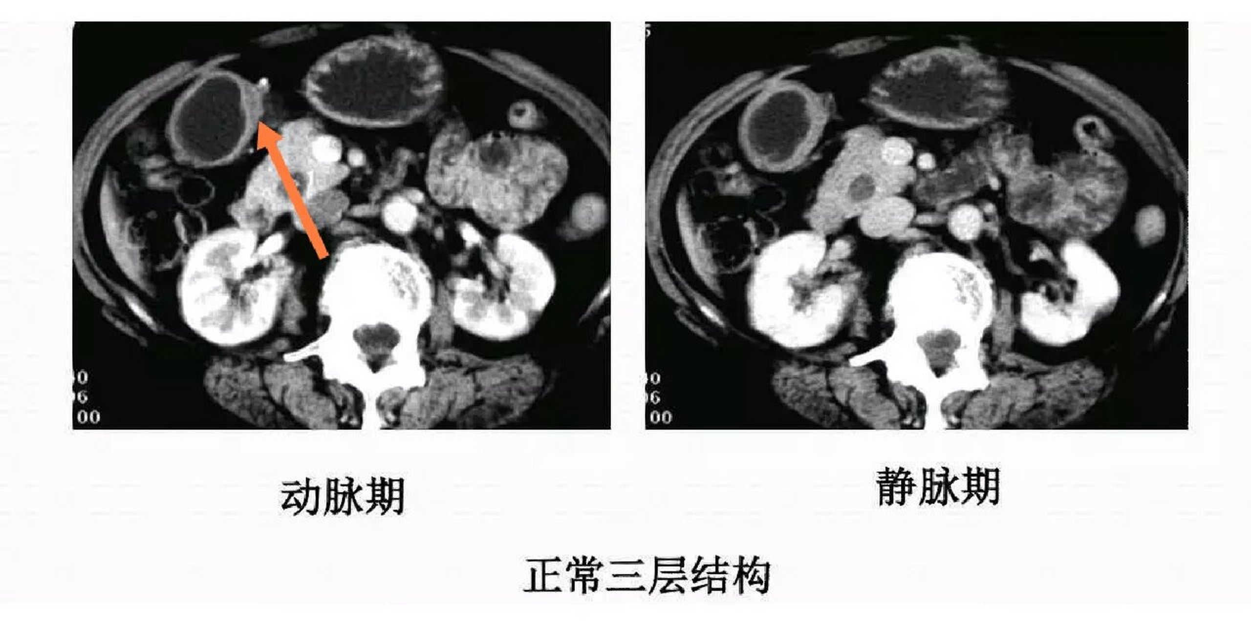 皮革胃CT图片