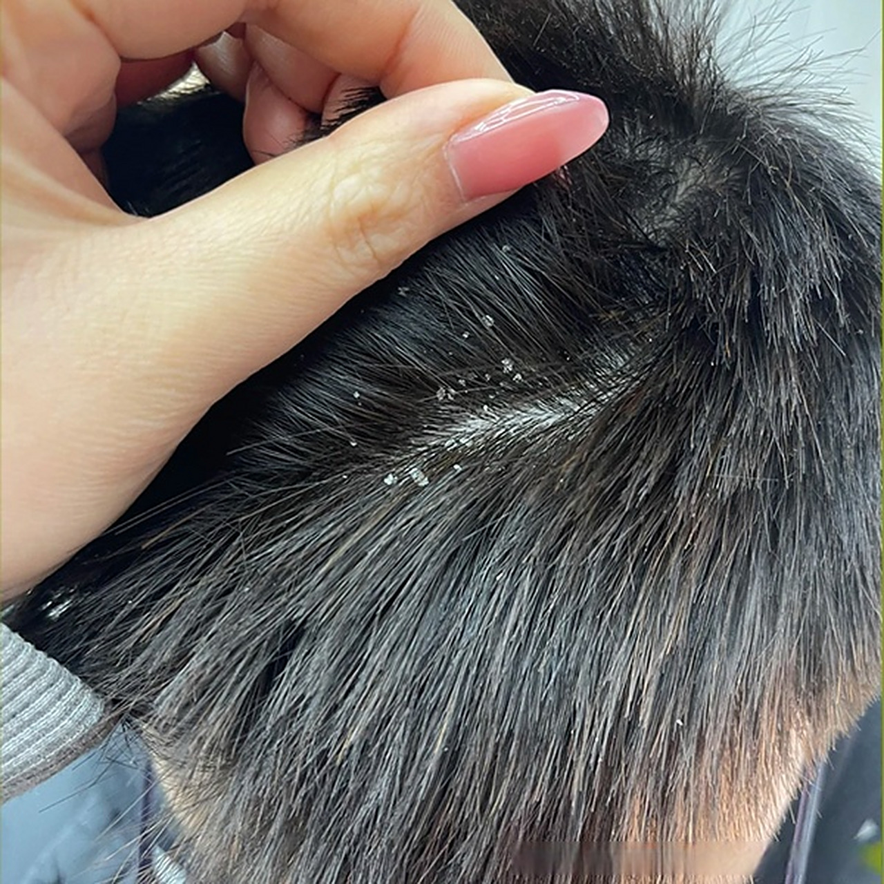 头屑的严重程度令我感到不安,不仅让我头痒不已,还导致头皮变得油腻