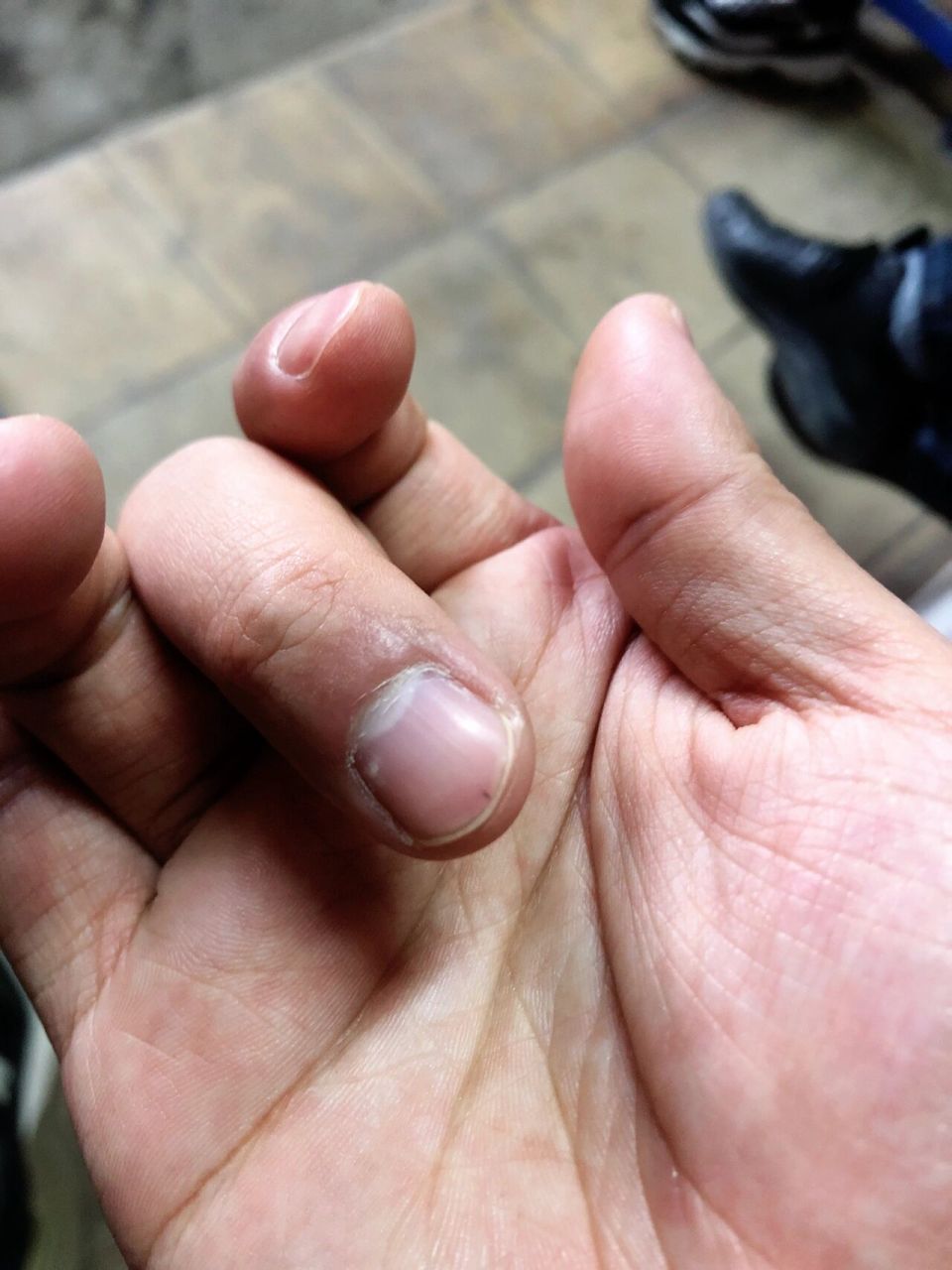 手指甲里长这个黑点咋回事?