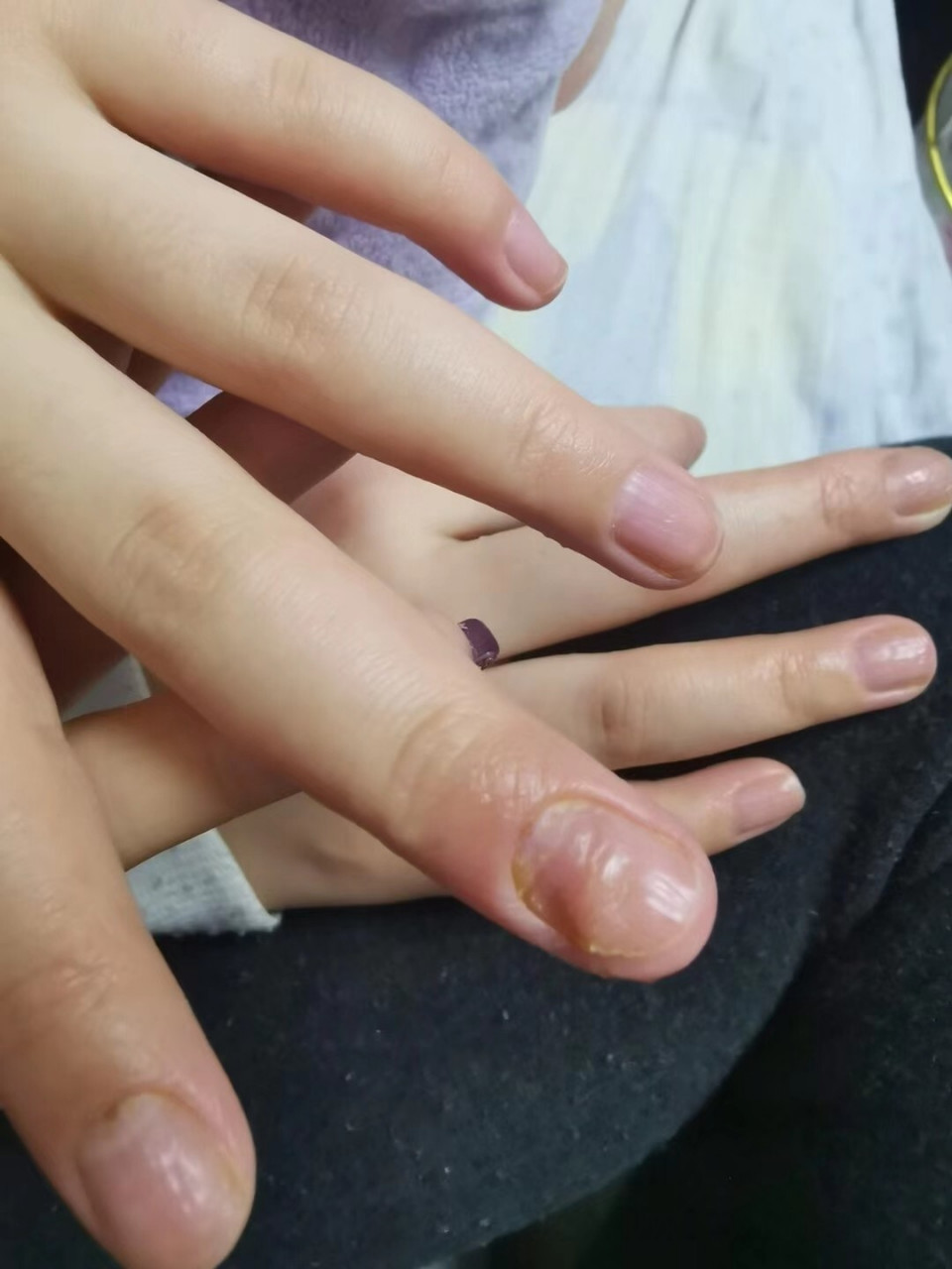 湿疹(汗疱疹 角质剥脱症)一个月的恢复情况～完美 指甲是因为之前发