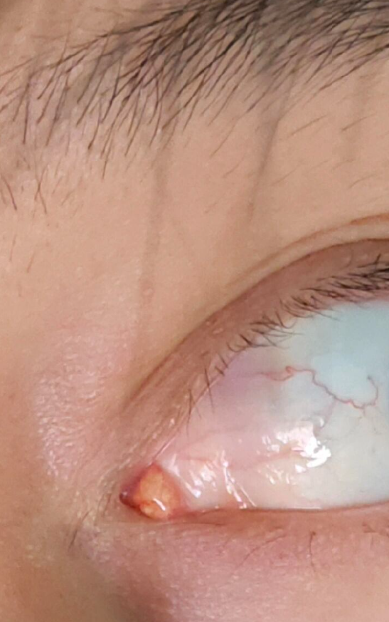 眼角内侧肿的小包可能是麦粒肿,结膜炎,泪阜炎或睑板腺囊肿引起的