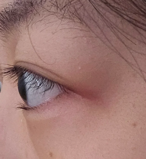高度近视导致眼球突出,目前没有特别有效的方法能让眼球完全恢复原