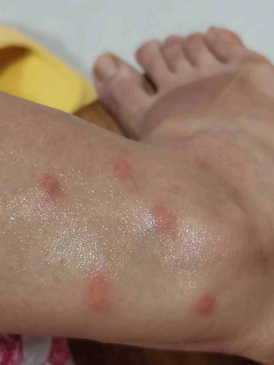 又痒又肿医生盆友建议用炉甘石洗剂 无极膏用