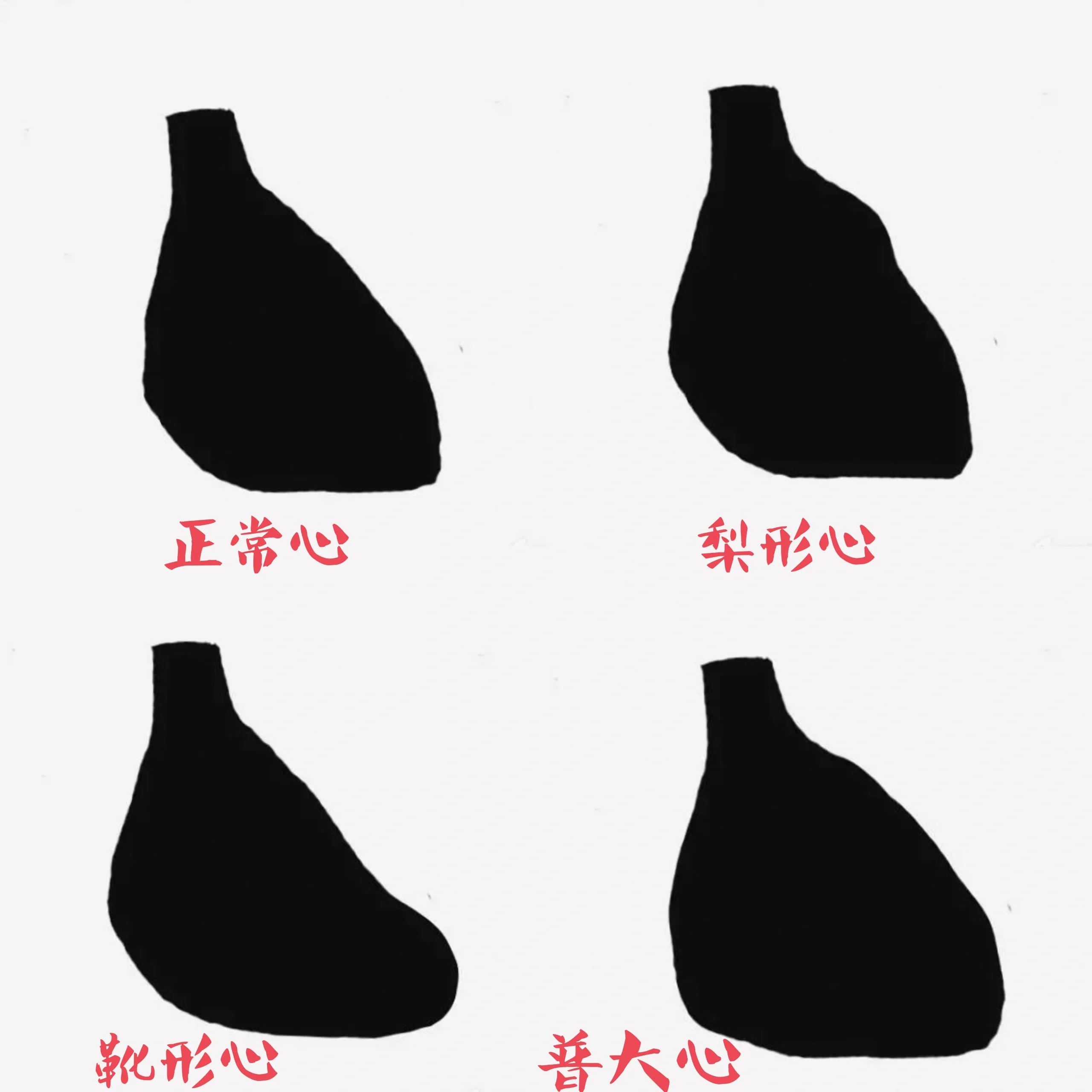 瓣膜病杂音;梨形/靴形/普大 心 心脏瓣膜病的特征性/典型杂音; 梨形心