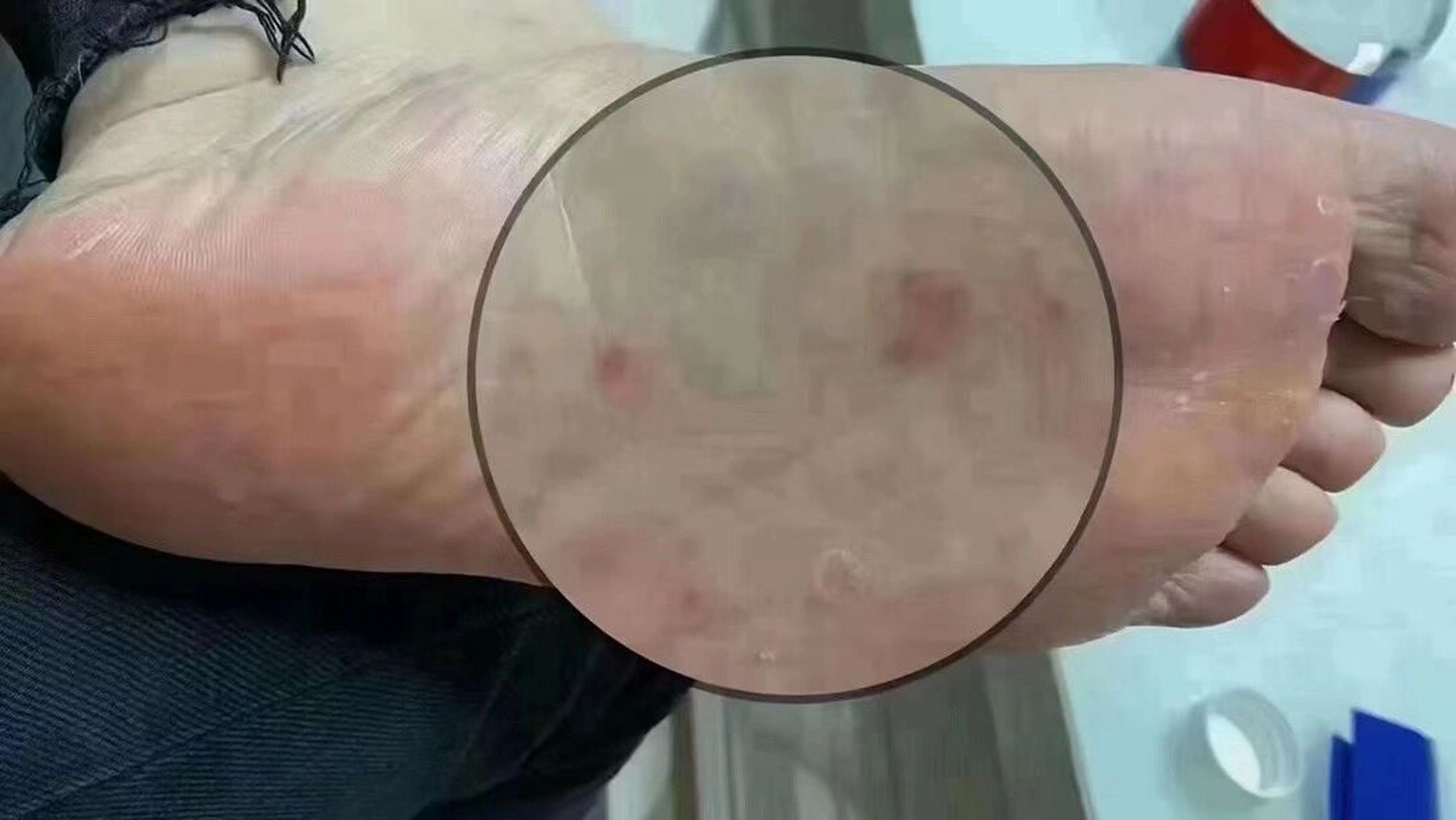 96:水泡型脚气 水泡型脚气一定不能挠破6015 一但破了里面的水