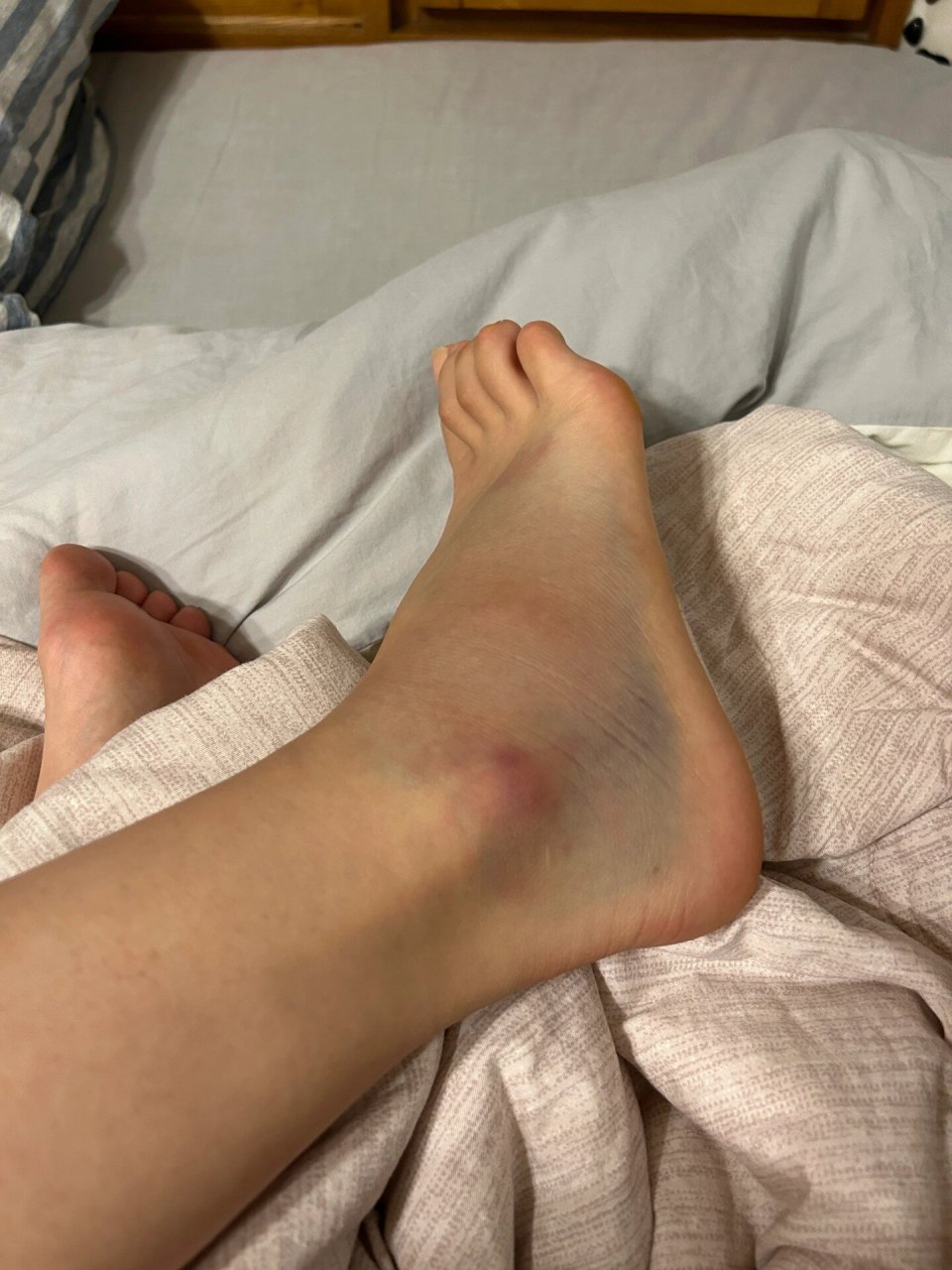 脚踝扭伤不完全攻略(自愈版) 崴脚千万严肃认真!别不当回事!